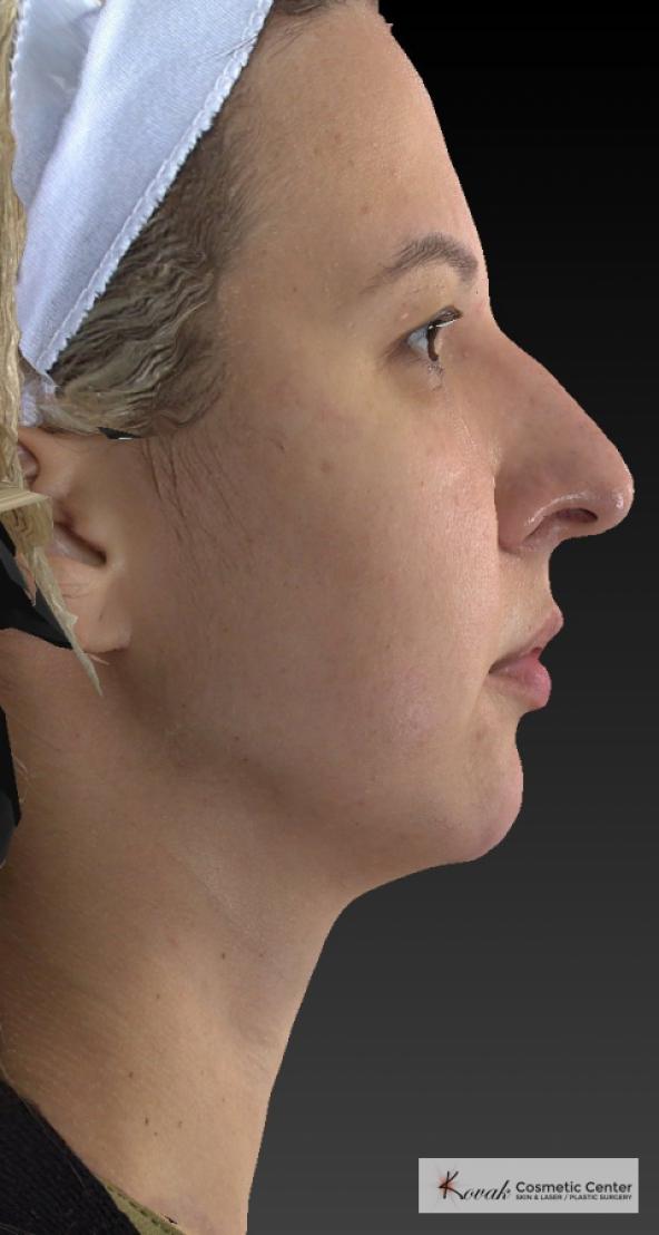 Restylane® Lyft: Patient 1 - After  