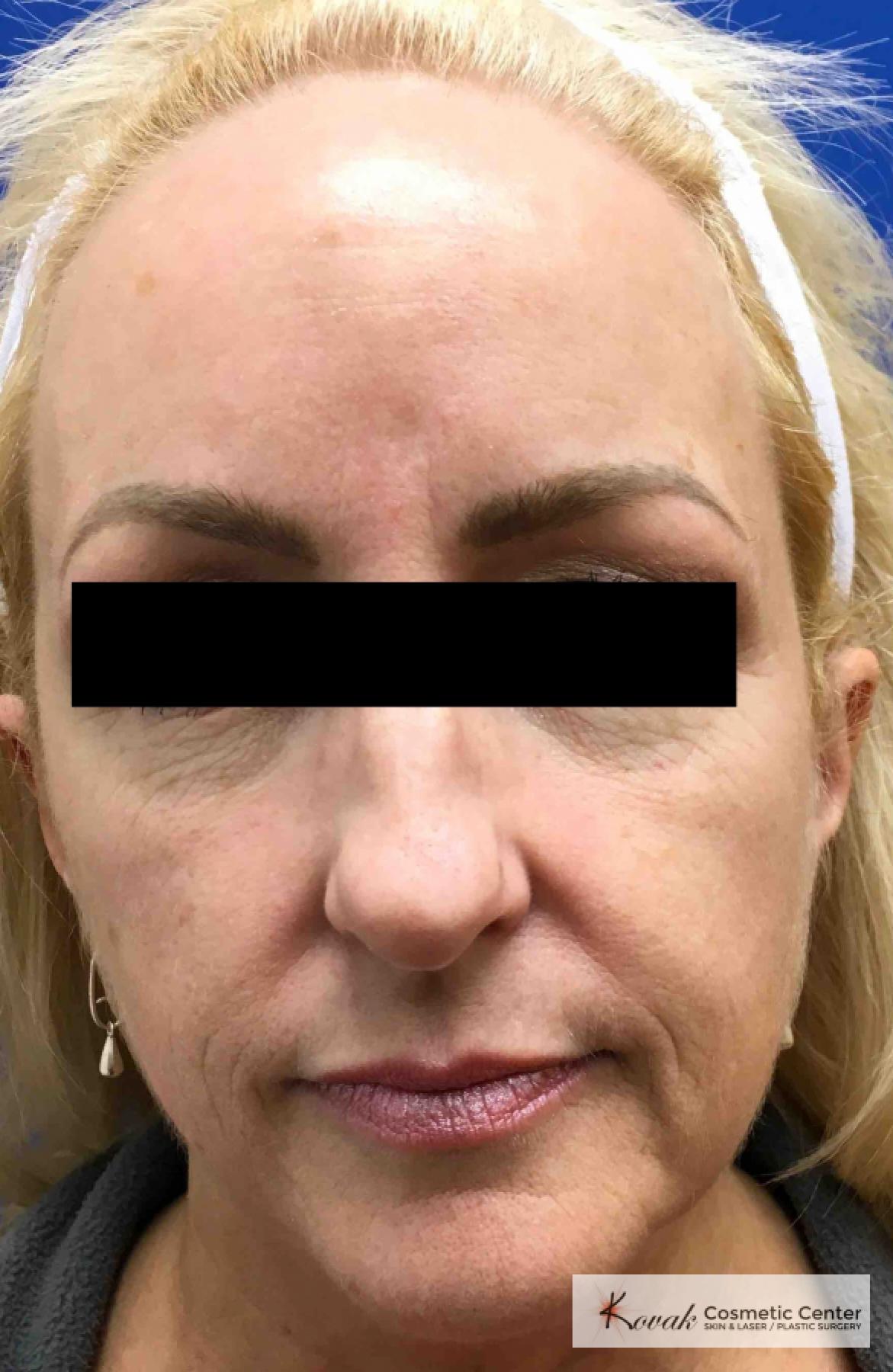 Sculptra®: Patient 6 - Before 