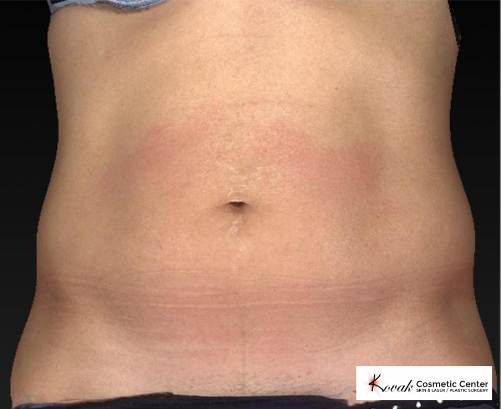 CoolSculpting®: Patient 9 - Before 