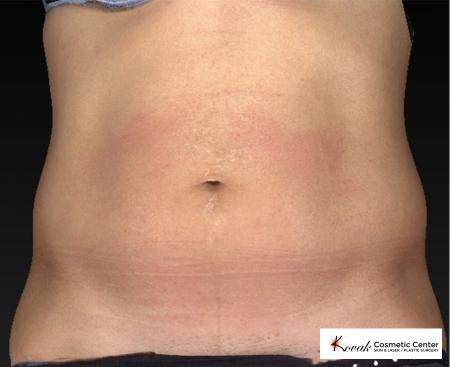 CoolSculpting®: Patient 6 - Before Image 1