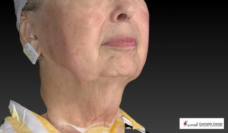 Kybella: Patient 3 - Before Image 2