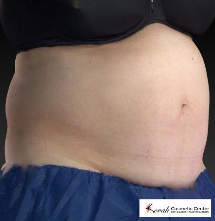 CoolSculpting®: Patient 8 - Before 2