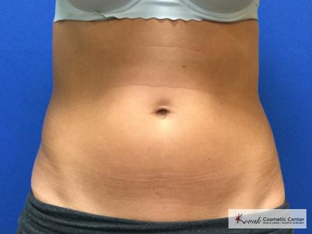 CoolSculpting the Abdomen on a 37 year old female - Before