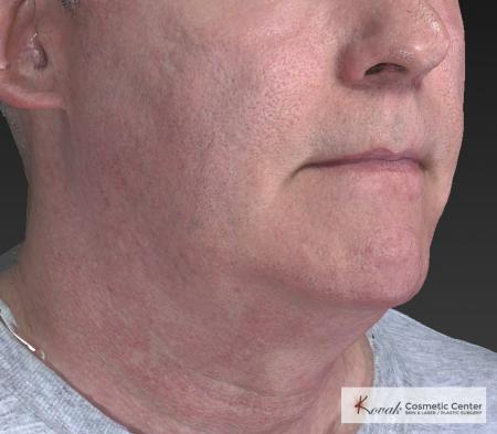 Kybella: Patient 4 - Before and After Image 4