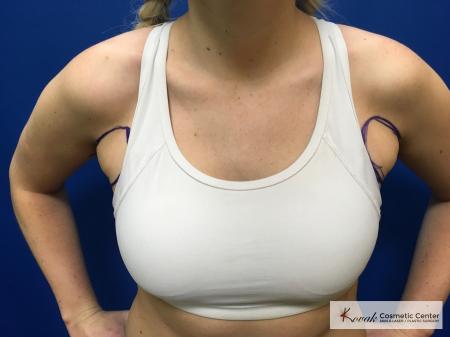 Laser Liposuction: Patient 4 - Before 2