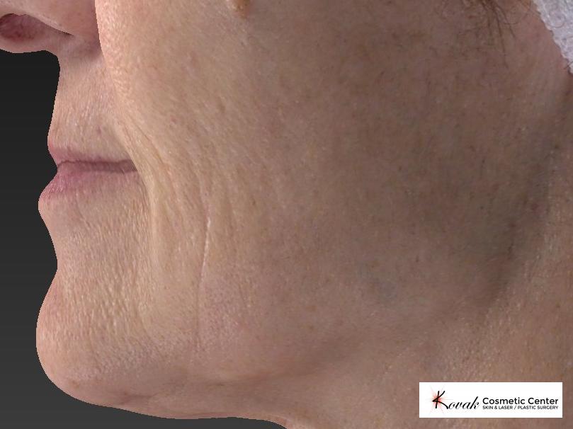 Restylane® Silk: Patient 2 - After 3