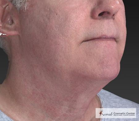 Kybella: Patient 4 - After Image 4