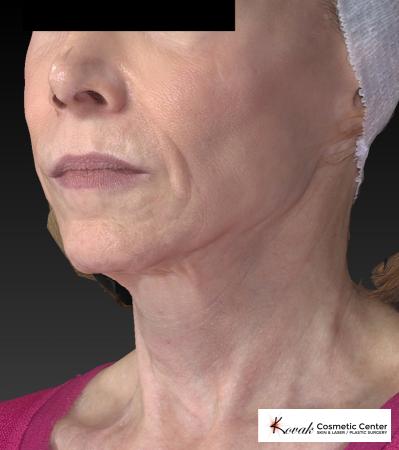 Sculptra®: Patient 1 - After 4