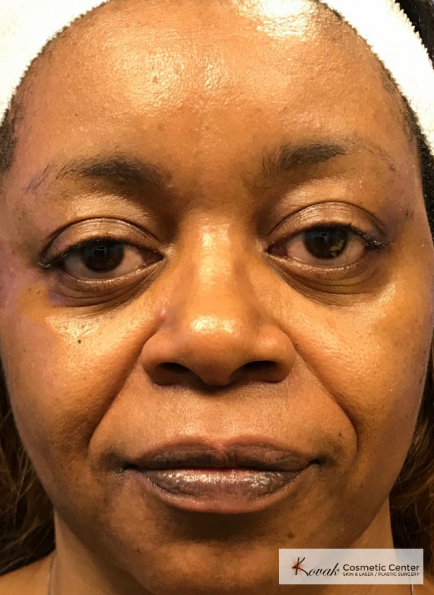 Lip Augmentation: Patient 1 - Before 