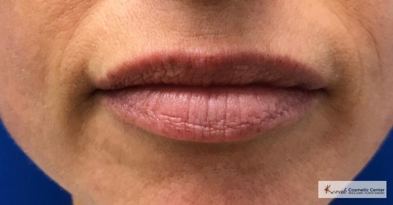Restylane® Silk: Patient 9 - After  