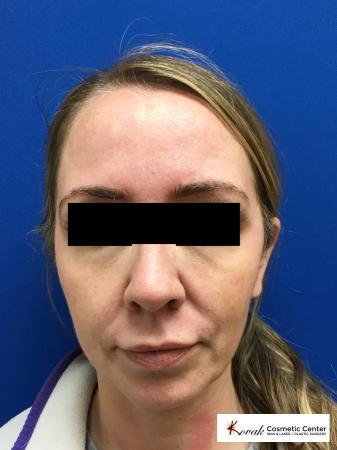 Sculptra®: Patient 6 - Before 1