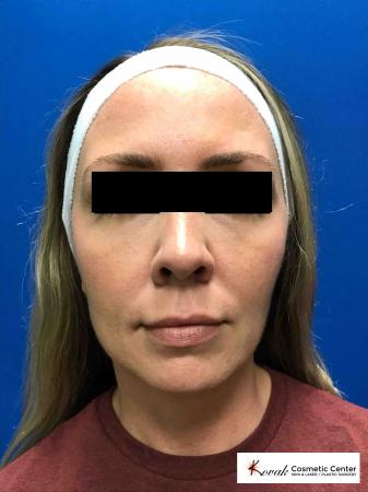 Sculptra®: Patient 6 - After 1