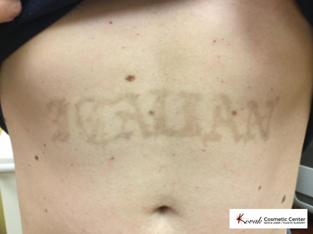Tattoo Removal on a 38 year old male - After  