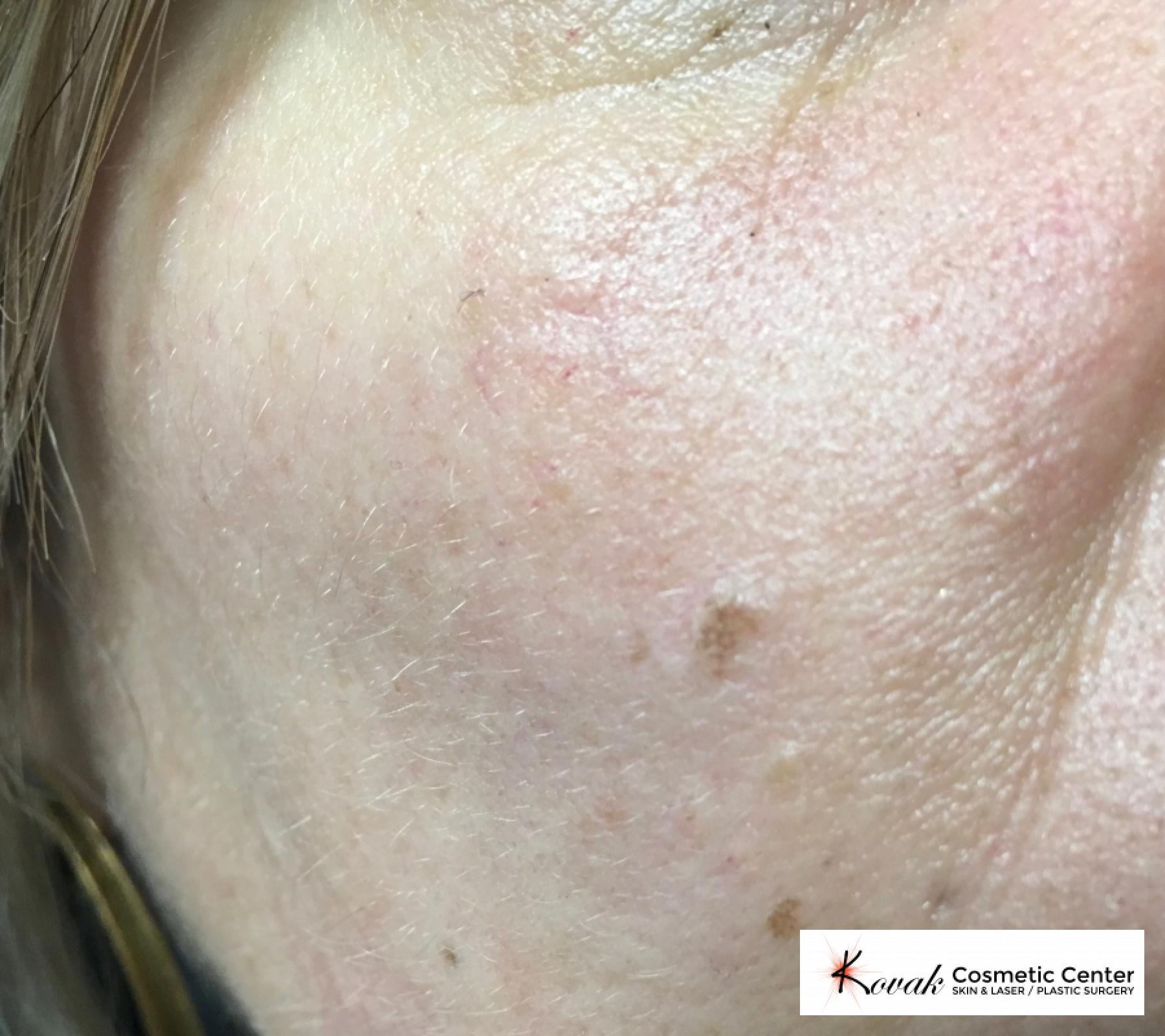Mole Removal: Patient 1 - After  