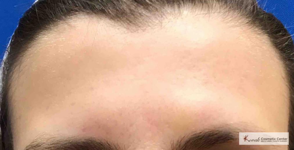 Injectables: Patient 3 - After  