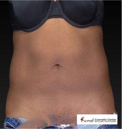 CoolSculpting®: Patient 15 - After 1