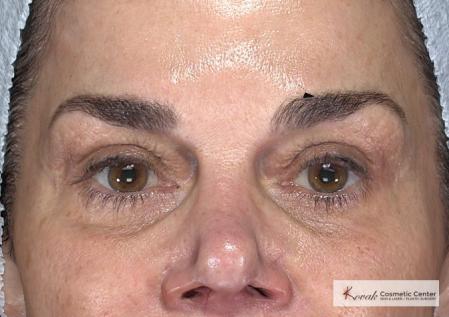 Laser Skin Resurfacing - Face: Patient 2 - After Image 4