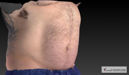 CoolSculpting®: Patient 20 - After 2