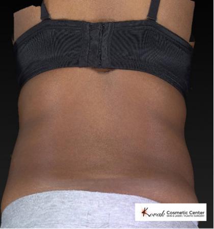 CoolSculpting®: Patient 15 - Before 2