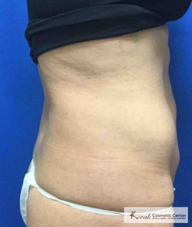 EMSCULPT®: Patient 2 - Before 3