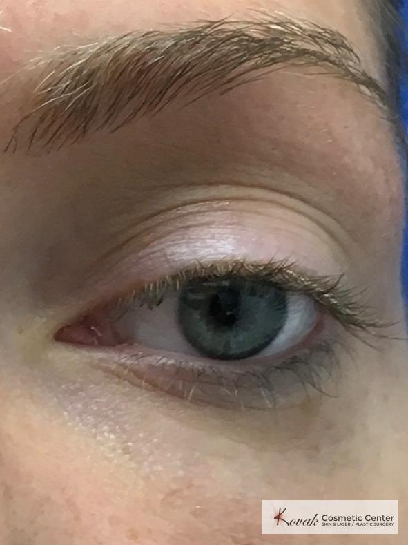 Dark Circle Treatment with Restylane Silk on a 29 year old female - After 2
