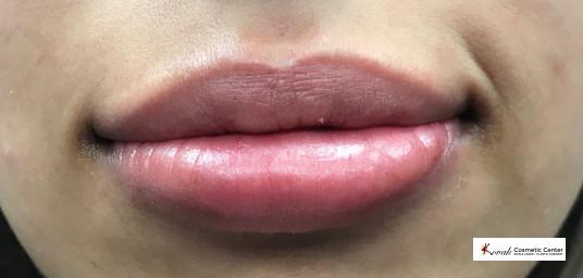 Restylane® Silk: Patient 6 - After  