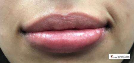 Restylane® Silk: Patient 6 - After 1
