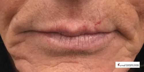 Restylane® Silk: Patient 3 - Before 