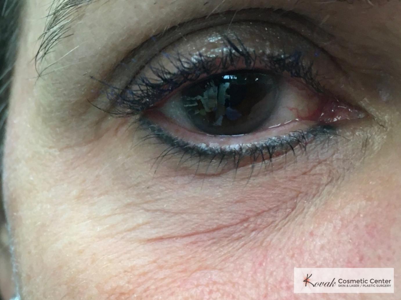 Under Eye Wrinkle Treatment with Agnes - Before 1