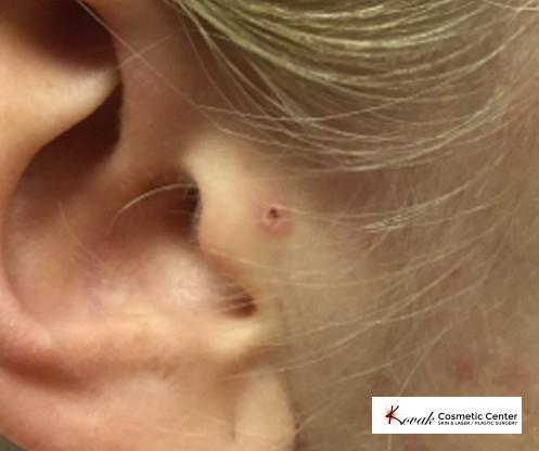 Mole Removal: Patient 3 - After  