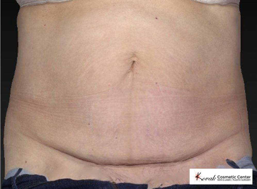 CoolSculpting®: Patient 8 - After  