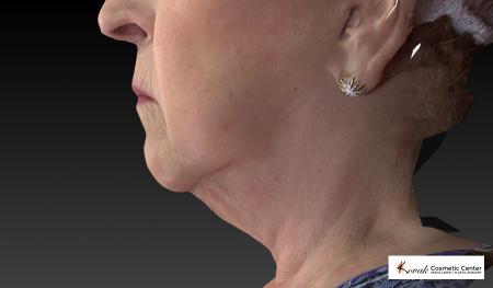CoolSculpting®: Patient 5 - Before and After 3