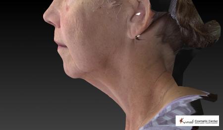 CoolSculpting®: Patient 6 - Before Image 2
