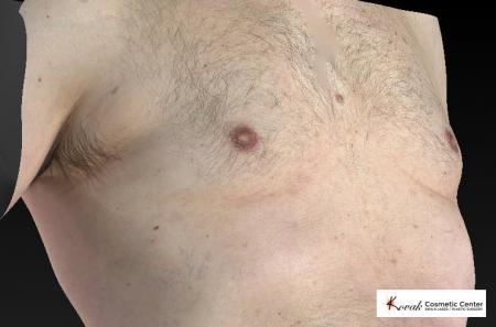 CoolSculpting®: Patient 7 - After 3