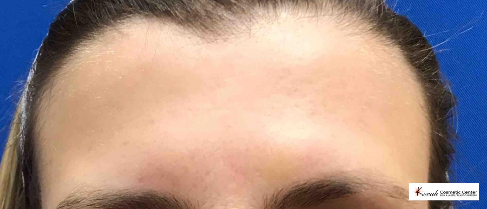 Restylane Silk for Forehead Lines on 43 year old female - After  