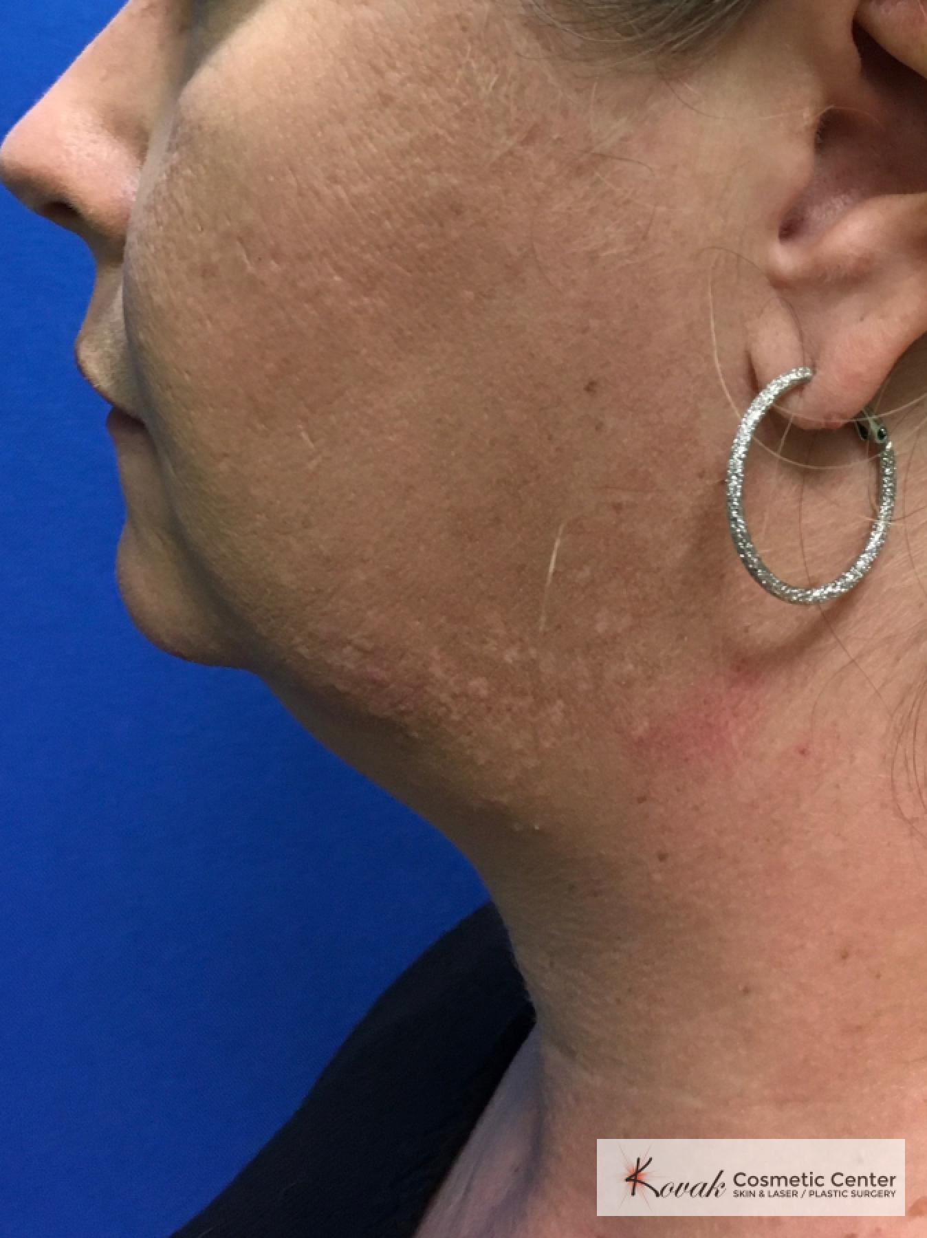 Laser Liposuction of the neck of a 44 year old female - Before 