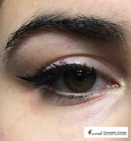 Eye Treatments: Patient 1 - After 1