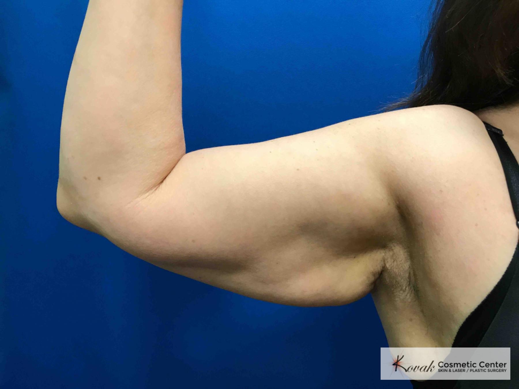 Laser Liposuction: Patient 5 - Before 