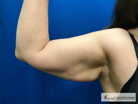 Laser Liposuction: Patient 5 - Before 1