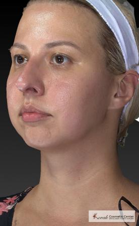 Restylane® Lyft: Patient 1 - Before 3