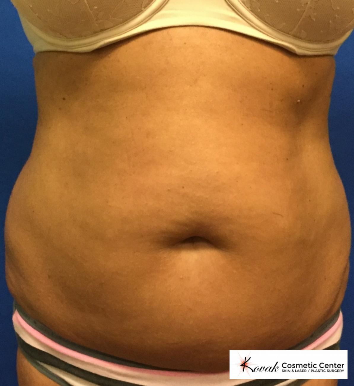 CoolSculpting®: Patient 1 - Before 