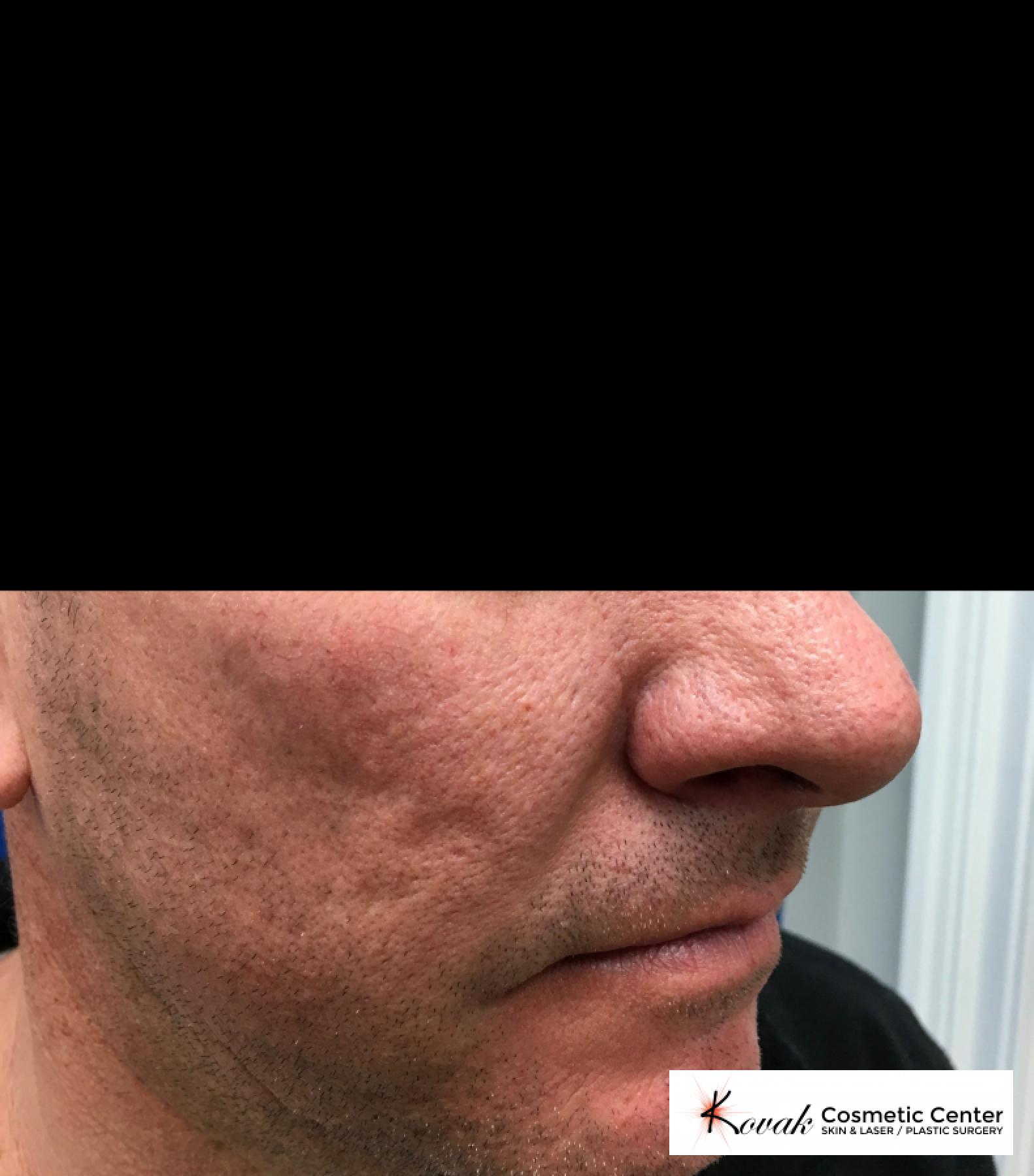 Juvéderm® XC: Patient 1 - Before 