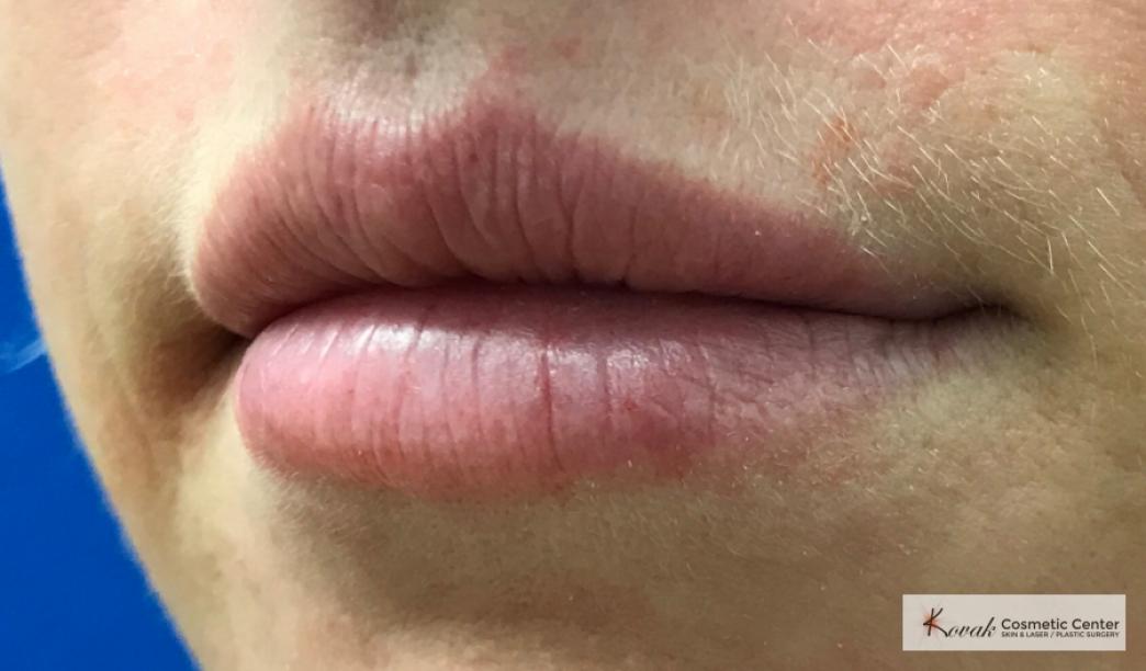 Lip Augmentation: Patient 2 - After  