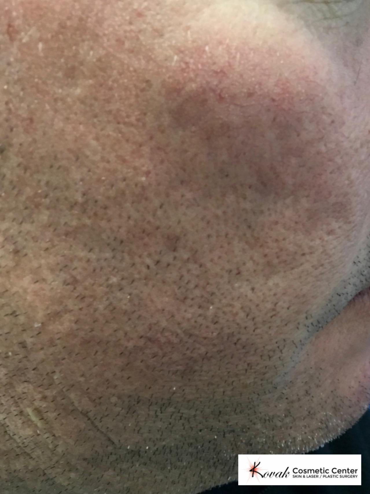 Acne Scars treated with Juvederm on 45 year old male - Before 