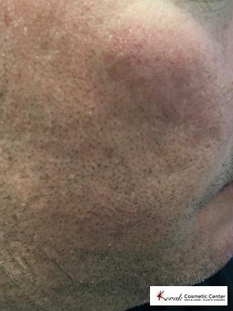 Acne Scars treated with Juvederm on 45 year old male - Before Image 1