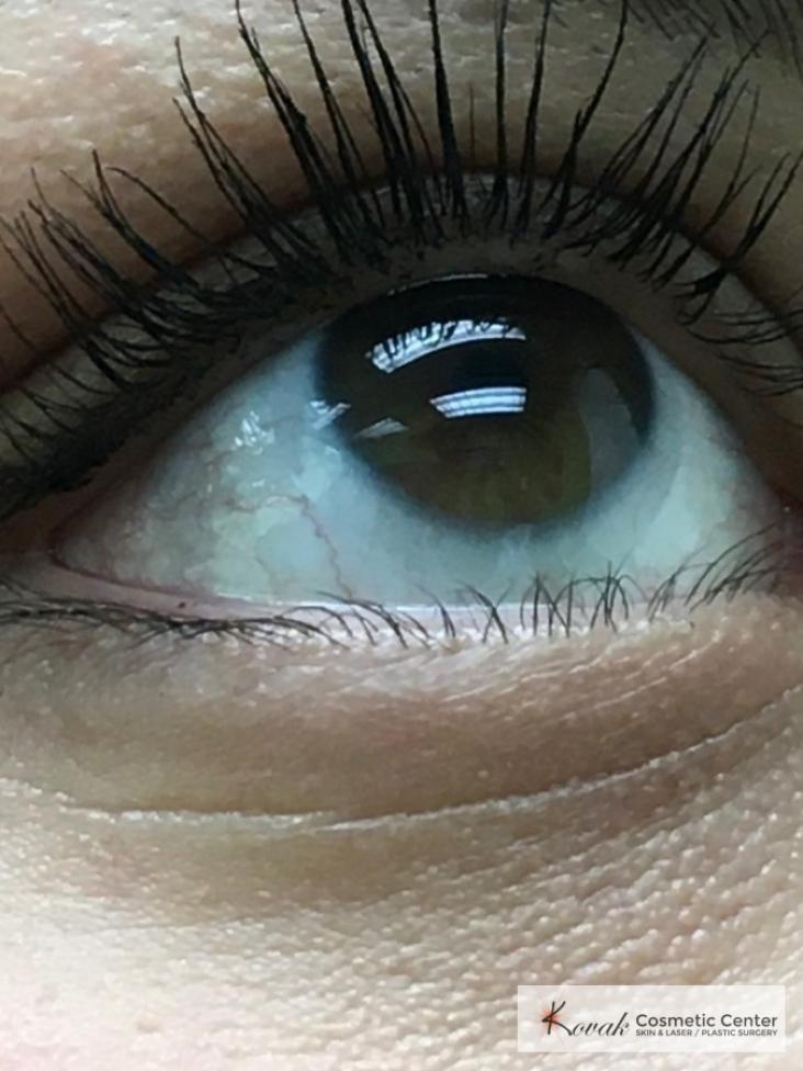 Mole Removal on 25 year old Female patient - After  