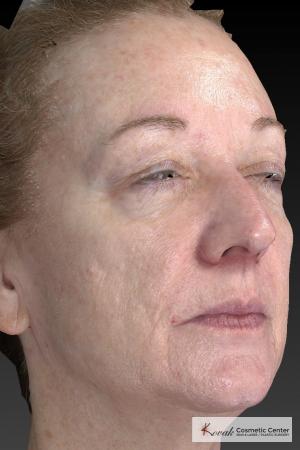 Tyte And Bryte – Face: Patient 6 - After Image 5