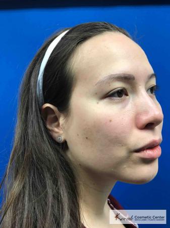 Restylane® Lyft: Patient 2 - After 4