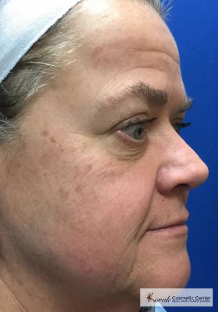 Restylane® Silk: Patient 13 - Before and After 3