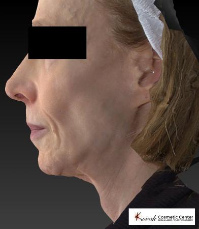 Sculptra®: Patient 1 - Before and After 5